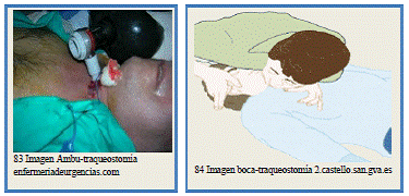 22. RCP EN EL PACIENTE TRAQUEOSTOMIZADO